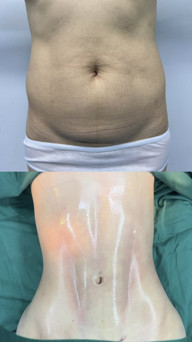 DrLeoSurgery's tweet photo. 从腰腹脂肪堆积、线条不够清晰，到腰线收紧、腹部轮廓更加利落——这次做的不只是“抽脂”，而是对整个腰腹比例进行重新塑形。✨

本案例进行：
✅ 腰腹360°环吸
✅ 腰侧精细塑形
✅ 腹部线条���整
✅ 马甲线轮廓成形

术后即刻就可以看到腰围与身体曲线的明显变化，接下来随着肿胀逐渐消退，线条还会继续恢复得更加自然、清晰。

💰 本案例实际手术费用：RMB 30,000
约合：
🇺🇸 USD 4,450
🇪🇺 EUR 3,850
🇸🇬 SGD 5,690
🇲🇾 MYR 18,060
🇮🇩 IDR 79,460,000

每个人的脂肪分布、皮肤弹性和基础条件不同，具体方案需要根据身体情况进行设计。

#腰腹环吸 #马甲线塑形 #抽脂塑形 #身体雕塑 #LEOU