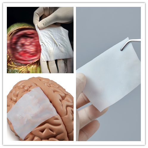KangerMedical's tweet photo. ¿Solución para defectos de duramadre? ⚡ ⚠️ Imagen educativa de procedimiento médico. Parche dural biomimético: evita fugas LCR y adherencias. Sin fascia autóloga, menor trauma quirúrgico. 📩 crystal@kangeryl.com #Neurocirugía #ParcheDural #ReparaciónDuramadre #Craneotomía https://t.co/ql4D7l6i5B