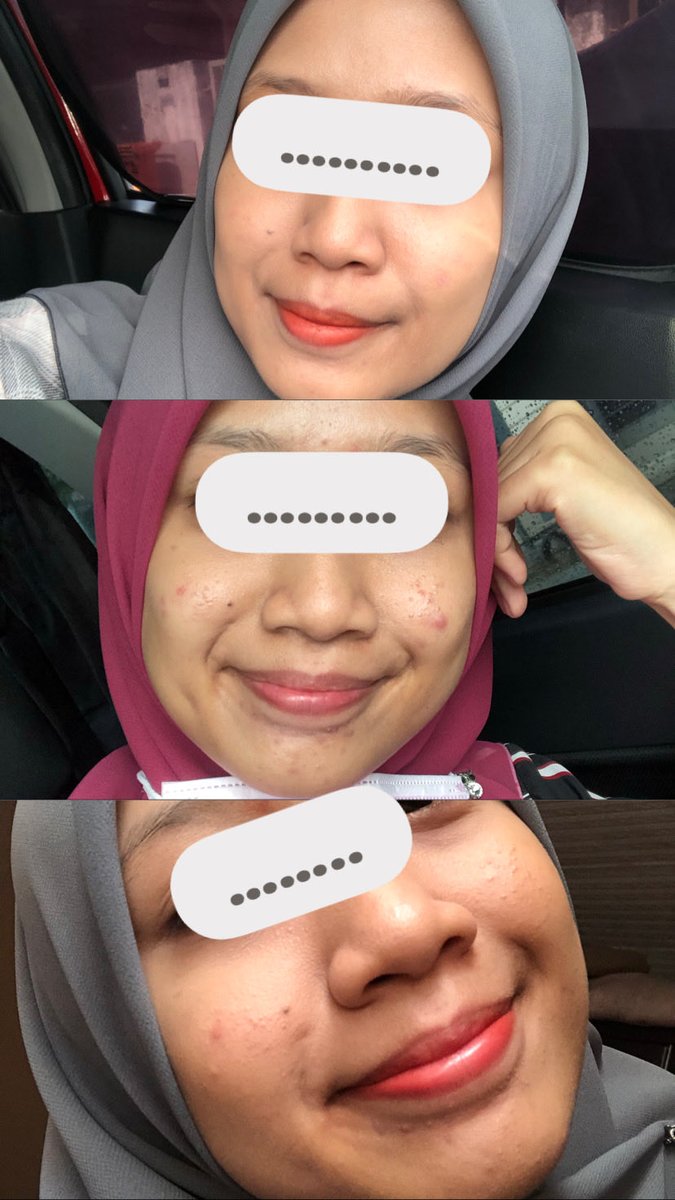 deeshrz's tweet photo. The product vs The result 
Forever my fav holy grails ✨ https://t.co/YKoNu1Dw6o