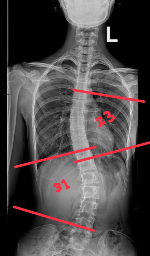 fawaz_physio's tweet photo. حالة من العيادة 🚨
في بداية السنة الحالية زارتني هذي المراجعة بشكوى (الجنف) مع بعض الشكوى من الام في اسفل الظهر. تم العمل على خطة علاجية مناسبة لحالتها وبعد دراسة دقيقة للاشعه، الحمدلله ظهور تحسن ملحوظ بعد ٦ اشهر من العلاج الطبيعي المتخصص لحالتها. 

هدف مشاركة هذه الحالة هو التحفيز بما ان الالتزام بالعلاج الطبيعي لفترة طويلة قد يكون صعب لكن قد تكون نتائجها مثمرة باذن الله. 

                بعد                                    قبل