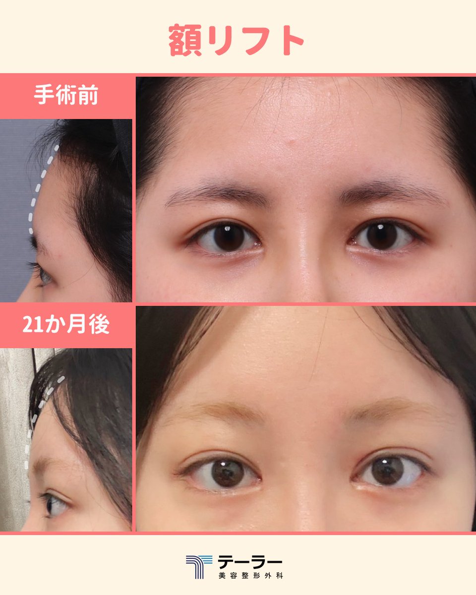 TAILORPS1's tweet photo. 【額リフトの Before&After】

額リフト手術を受けると弛んだ瞼や眉毛が上がり
隠れていた二重のラインが見えるようになるだけでなく、
額も自然と少し丸くなります✨

額リフトを受ける前に
額に脂肪移植をしたり、
ヒアルロン酸を入れないで、
まずカウンセリングを受けてみましょう💖

⚠️手術の結果は皮膚の弾力や動き、伸びしろなどにより、個人差があります。

💌 ご予約・お問い合わせはプロフィールのリンクから

#額リフト
#内視鏡額リフト
#額挙上
#症例写真
#テーラー美容外科