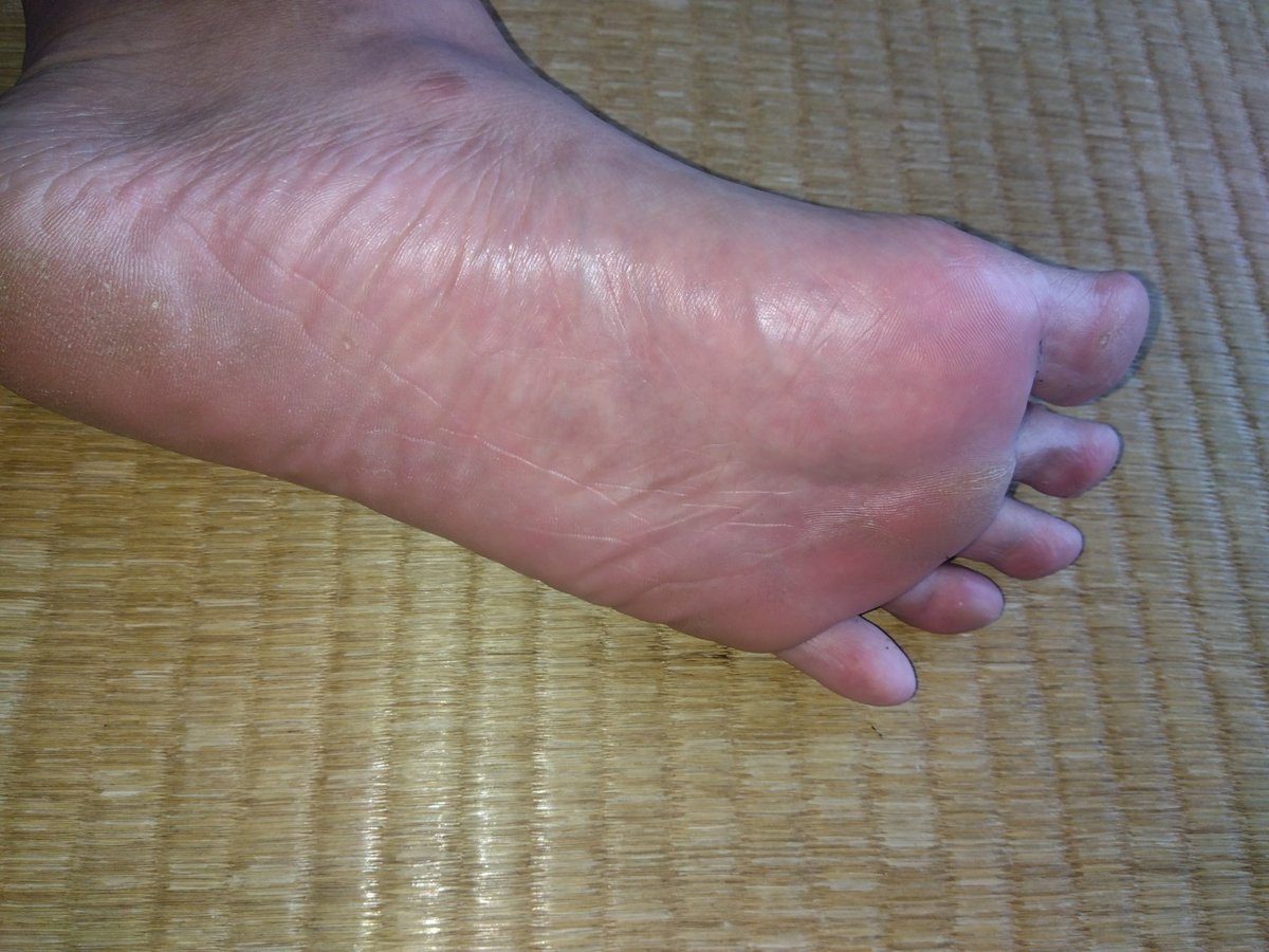 Xo4n3's tweet photo. 今日も猛暑の中1日じっくり育て上げた熟成足裏👣💦
指股に溜まった黒い汚れと、汗ばんで赤くなった足裏全体を存分にどうぞ ( ◜◡◝ )
​#男の足裏 #蒸れ足 #安全靴 #扁平足
#MaleFeet #GayFeet #PiesMasculinos https://t.co/xLbCT4s6iB