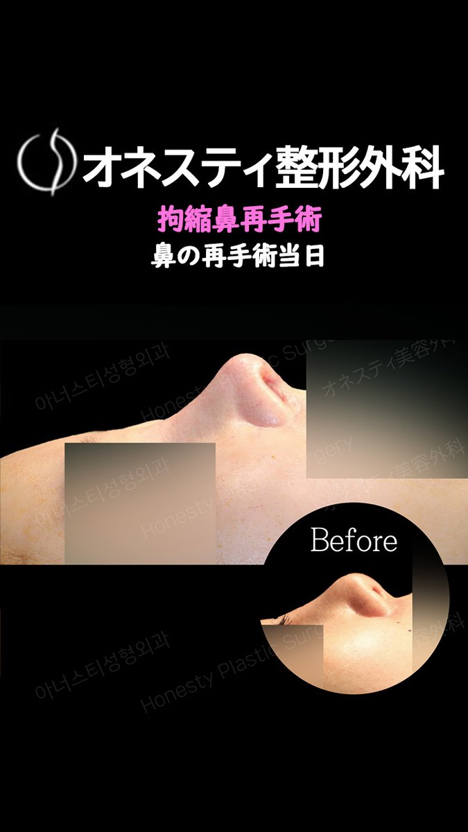 honestyps_jp's tweet photo. 「つまみ鼻・団子鼻・引っ込んだ鼻柱を整えて、さらに鼻唇角まで調整。」

なのに、どうしてこんなに綺麗な鼻になれるの？
オネスティ整形外科の“美鼻の秘密”とは？

お問い合わせはラインにて
@honestyps

#鼻再手術 #拘縮鼻 #鼻拘縮
#鼻整形修正 #鼻整形症例 https://t.co/11e0SOaXDq