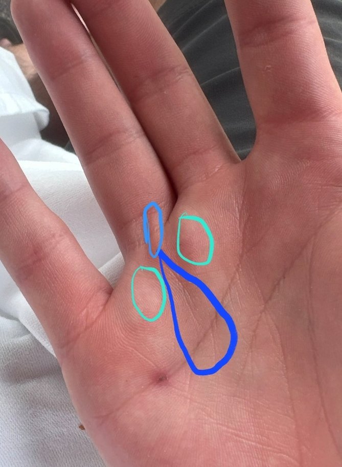 ybtweetz's tweet photo. @pigshitsonballs @kirnj02 Pit in dark blue, nodules in greenish, cord in light blue. Again, maybe it's an optical illusion, but you confirming your Nordic ancestry plus this picture makes me feel like I made a reddit ass comment... I thought you knew.. https://t.co/GoleZhFYut