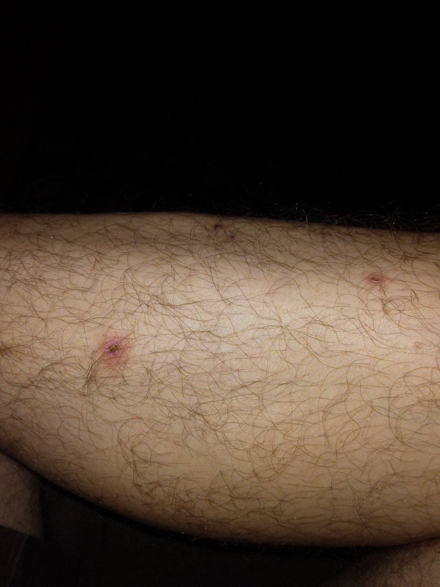 1nonly10_4's tweet photo. @bluemontauk You go gurl! You do got it
Crazy I didn't really think about it until now but I had some spider bite me in the woods 2 weeks ago, twice. It pitted after it turned black and there was some pain.. and discharge, ofcourse. 
But it's still there, hard knot with scab. 2 friggen weeks! https://t.co/yzyl72fzXn