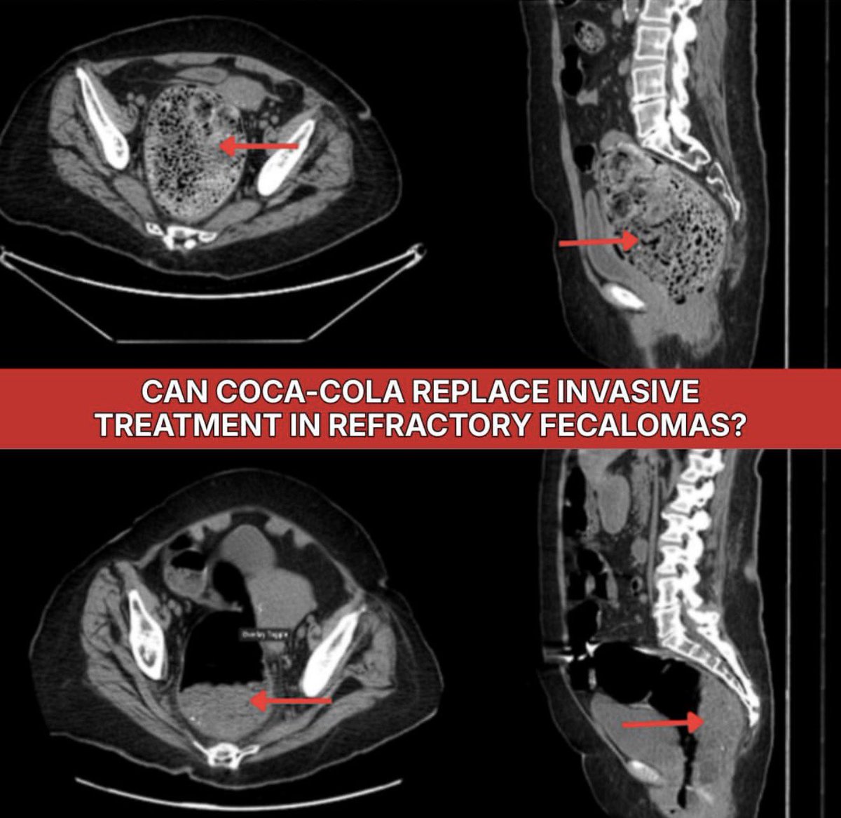 drkeithsiau's tweet photo. Coca-Cola for severe constipation?

An 82 year old lady with dementia, chronic constipation and poor mobility presented with abdominal pain, distension, nausea and vomiting, without passing neither stool nor flatus for several days.

CT abdomen found a 12.2 × 10.5 cm faecaloma impacted in the sigmoid colon and rectum, without perforation. Manual disimpaction was unsuccessful, while polyethylene glycol, senna, mineral oil and sodium phosphate enemas delivered no improvement. Repeat CT after five days showed persistent impaction.

On day 13, clinicians administered a 1L “full fat” Coca-Cola enema, retained for 60 minutes. The patient was placed into the supine position, and the enema bag was raised as high as the tubing would allow. After approximately 10 minutes, the entirety of the Classic Coca-Cola had been instilled. The hose was then clamped, and the enema was allowed to dwell for 60 minutes, before being released.

Within 24 hours, pain and vomiting resolved and CT demonstrated approximately 50% reduction in fecaloma size. A second 1L Coca-Cola enema on day 16 resulted in complete symptomatic resolution, avoiding endoscopic or surgical intervention.

Coca-Cola may soften fecalomas through its acidity, carbonation and mucolytic effects, but evidence remains limited to fewer than a dozen case reports.

📸: Cureus