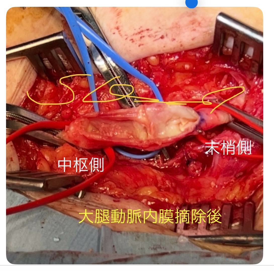 aWB7Rv8sG8TnBMS's tweet photo. 大腿動脈の限局性の動脈硬化
病変は縦に切開して内膜ごと
摘除すること出来ます。 https://t.co/wns0Xjb5tw