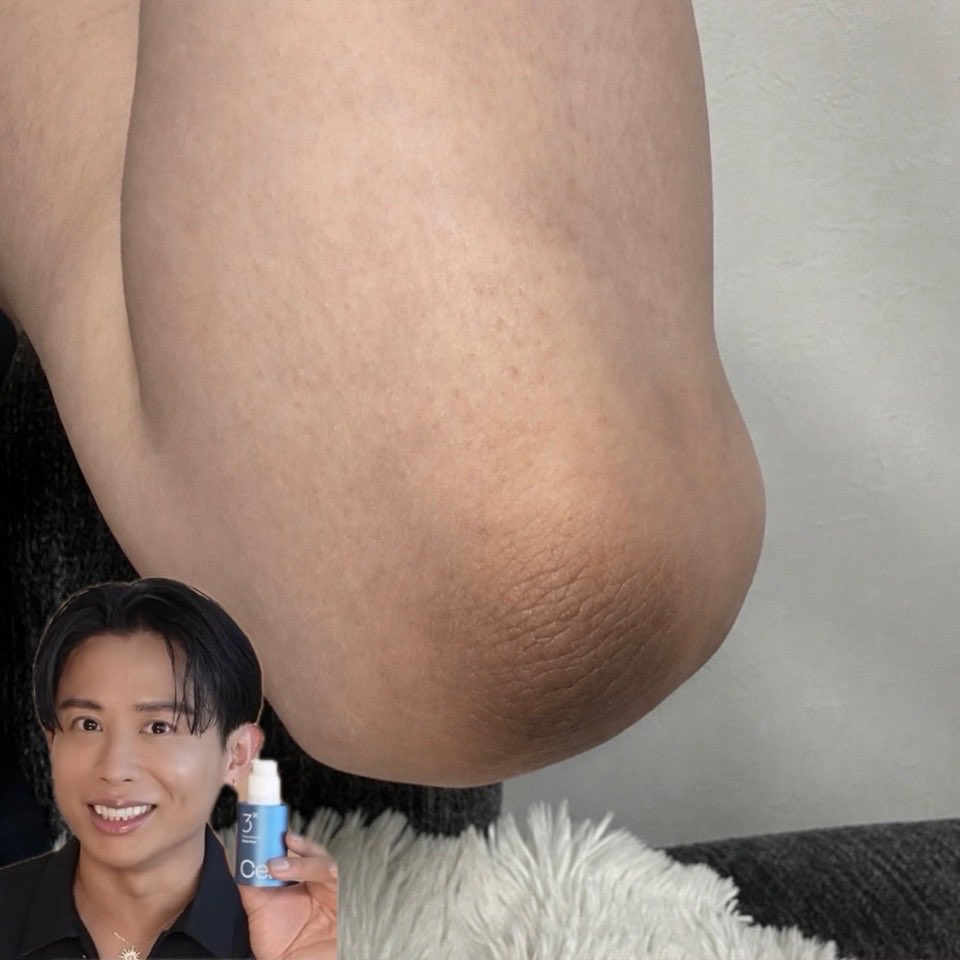 l1jqea's tweet photo. 【小田切】肘ピンクになれたありがとう。 https://t.co/L1tvVv4ea5