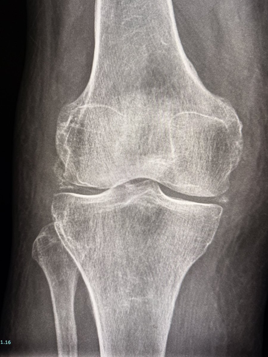 samrad77's tweet photo. Chondrocalcinosis. Where to look?

Look at the menisci. Look at the articular cartilage, particularly along the femoral condyles. Here, it is nicely seen posteriorly.

Then look for effusion and soft tissue edema. Both are striking here, while degenerative change is minimal.

Large effusion + little OA + chondrocalcinosis = think acute CPPD.

But don’t forget infection.

Aspirate the joint. Exclude infection. Look for CPP crystals.

—pearls, pitfalls and wisdom from my reporting list