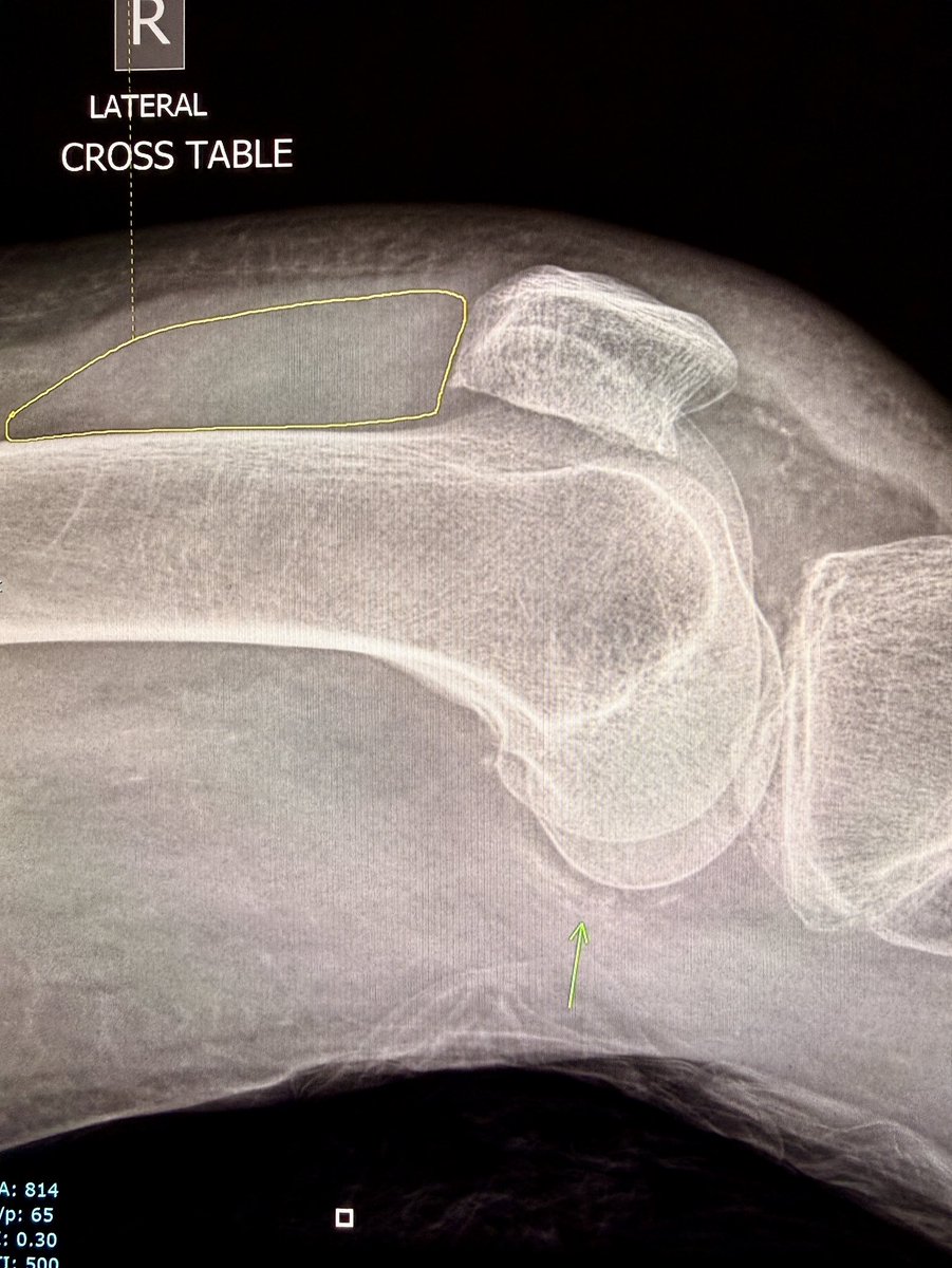 samrad77's tweet photo. Chondrocalcinosis. Where to look?

Look at the menisci. Look at the articular cartilage, particularly along the femoral condyles. Here, it is nicely seen posteriorly.

Then look for effusion and soft tissue edema. Both are striking here, while degenerative change is minimal.

Large effusion + little OA + chondrocalcinosis = think acute CPPD.

But don’t forget infection.

Aspirate the joint. Exclude infection. Look for CPP crystals.

—pearls, pitfalls and wisdom from my reporting list
