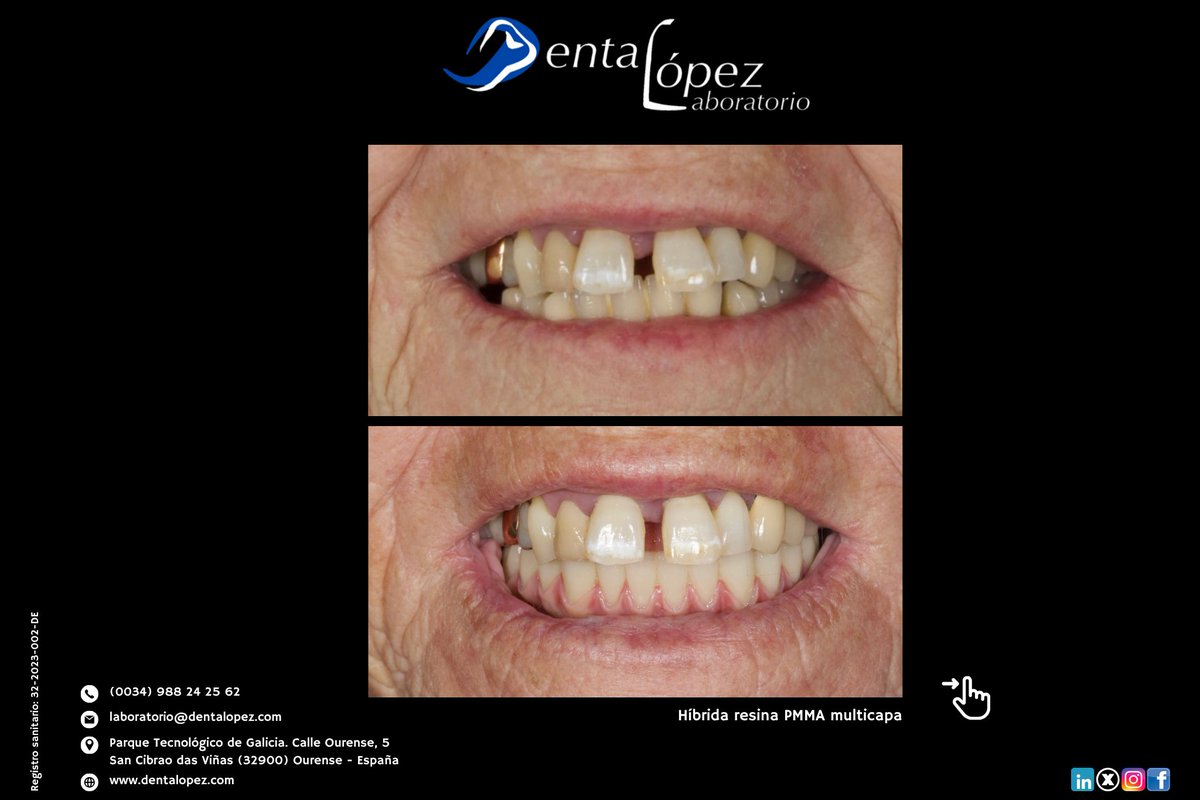 DentaLopez's tweet photo. Una rehabilitación completa exige mucho más que fabricar dientes. En este caso: híbrida de resina PMMA multicapa, con especial atención a anatomía, estética y caracterización gingival.
👉 https://t.co/AaoZIgsTFX #ProtesisDental #Implantologia #CADCAM #LaboratorioDental https://t.co/uvBHajOeMQ