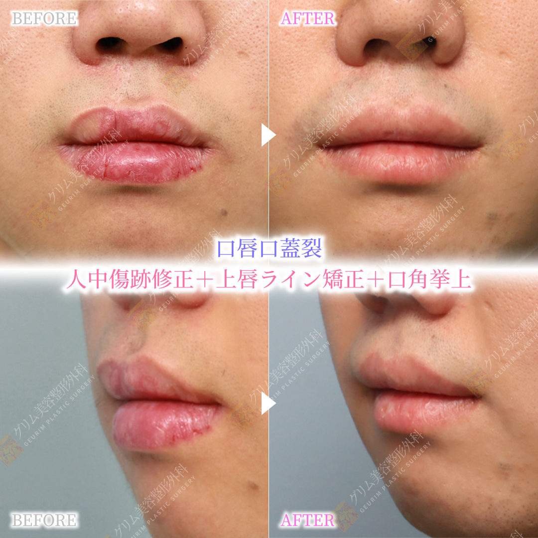 geurimjp's tweet photo. 【症例写真】20代男性｜就職活動を控えた口唇口蓋裂・口元整形✨

💡 患者様のお悩みとご要望🧐

✅幼少期の口唇口蓋裂手術による人中の傷跡が気になる⚡️

✅上唇のラインが左右非対称で、口元が歪んで見えてしまう🫦

✅就活の面接に向けて、清潔感があり好印象を与える口元になりた���💋

男性の場合、メイク💄でカバーすることが難しいため、「素顔のままでどれだけナチュラルに改善できるか」が
非常に重要❣️になります。

 💡グリム美容整形外科の複合アプローチ🏥
当院では、患者様のお悩みに合わせて
以下の3つの施術を同時❣️に行いました。

💎人中傷跡修正✨
長年のノウハウと微細縫合技術を用い、引きつれて目立っていた人中の傷跡を丁寧に修正します。

💎上唇ライン矯正✨
リップラインと山の左右差を整え、顔全体の黄金比に合わせた綺麗な上唇のラインを作ります。

💎口角挙上✨
下がって見えがちな口角を自然に引き上げ⬆️
面接でも明るく爽やかな印象を与えられるように仕上げます。

✨ 施術後の変化💕
人中から上唇にかけての傷跡が格段に目立たなくなり、
唇のバランスが整ったことで清潔感と信頼感のある
💋口元へ生まれ変わりました。
無事に手術を終えられ、自信を持って就職活動に臨んでいただける状態になりました🤩

🍒ご予約・お問い合わせは公式LINEへ📲  ID: grkoojp https://t.co/yvQL6PhVus 

#人中短縮 #口唇裂 #口唇口蓋裂 #韓国美容 #韓国整形 #渡韓 #修正手術 #傷跡 #口角挙上 #唇 #リップライン #メンズ整形 #就活

 https://t.co/81I1IWPkrE #Amebaブログ #アメブロ