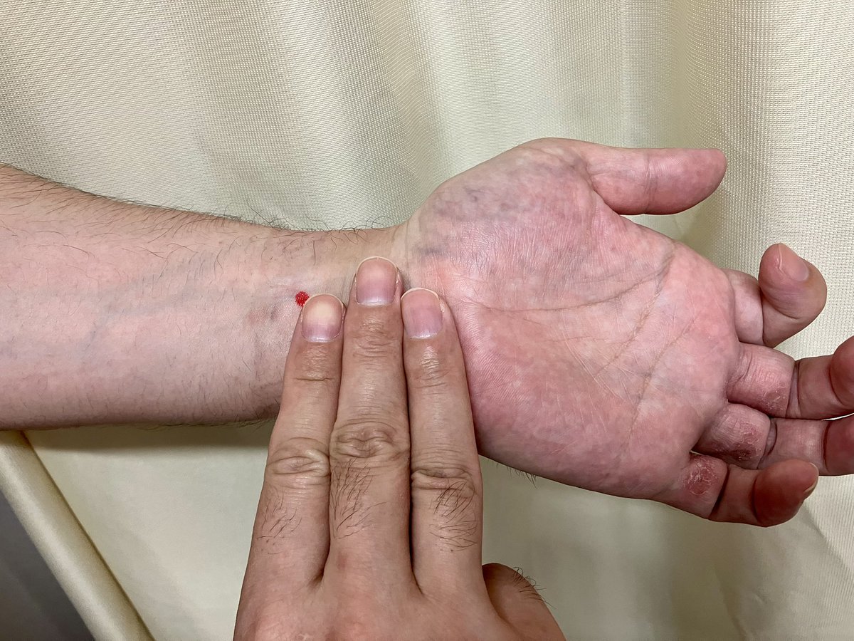 sechindo's tweet photo. 【ツボ紹介｜内関】台風シーズン、気圧変化で「なんとなく気持ち悪い」と感じる方へ。手首のシワから指3本分上、2本のすじの間にある「内関」を30秒ほどやさしく押してみてください。吐き気や乗り物酔いにも用いられる代表的なツボです。外出時は安全第一で🌿 #台風 #ツボ #鍼灸 #漢方 #世珍堂 https://t.co/uvg6fYuEhZ