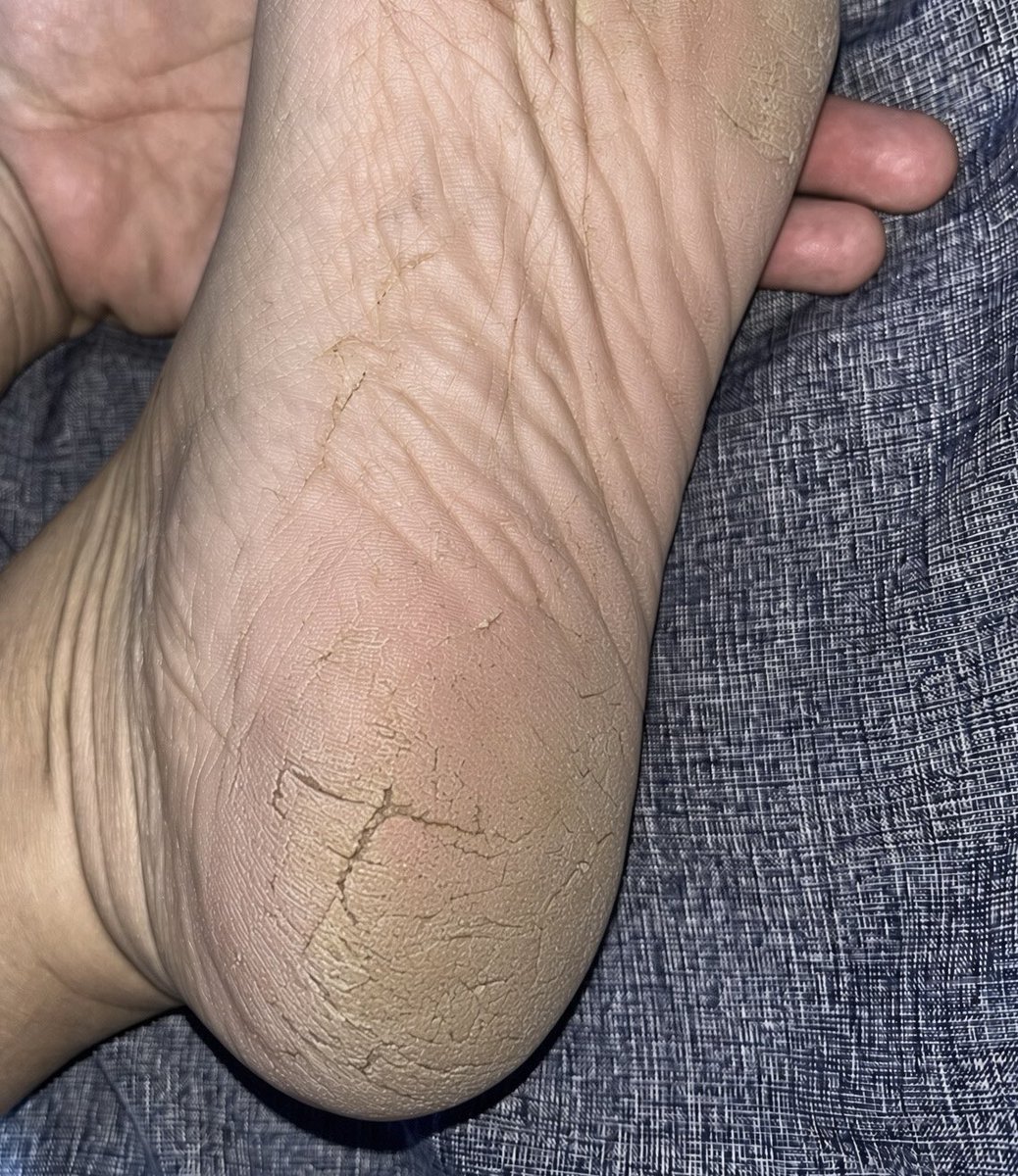 zarasabrenee's tweet photo. Gaperlu kesalon atau klinik, ngikutin step-step ini kaki kapalan pecah-pecah jadi mulus lg beneran 😭👏🏻 https://t.co/Mj9N7i63e7
