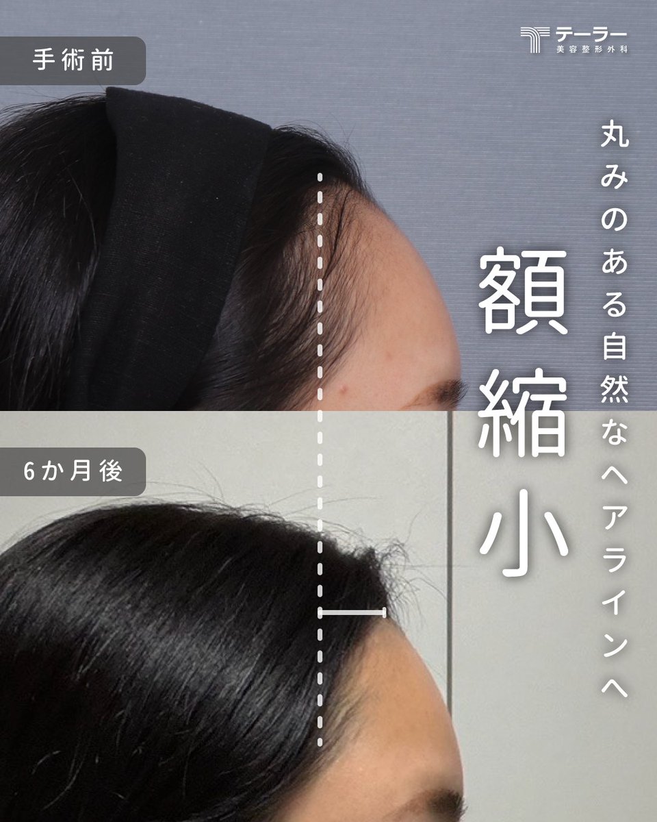 TAILORPS1's tweet photo. 【額縮小 Before&After】産毛は完全に消えますか？

ヘアラインの後ろ側にも産毛が隠れており
そこからも産毛が生えてくるため
完全に消えるわけではありません💡

テーラーでは
両サイドにある自然な産毛を
最大限に活かしながら手術を行っています🪄

個人差はありますが
半分以上の産毛が残る場合が多いため
より自���なヘアラインに仕上がります💖

⚠️手術の結果は皮膚の弾力や動き、伸びしろなどにより、個人差があります。

💌 ご予約・お問い合わせはプロフィールのリンクから！

#額縮小
#ビフォーアフター
#小顔手術
#韓国整形
#テーラー美容外科