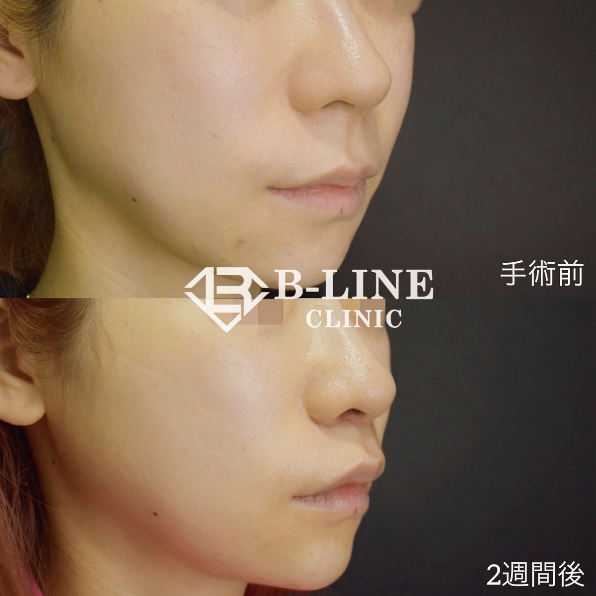 dr_koikeyasu's tweet photo. 【人中短縮手術】　
2週間後　⭐️モニター価格15万~⭐️

人中短縮するだけで中顔面が短くなり、劇的に顔のバランスが良くなります✨
同時に自然なCカールを形成することで可愛らしい口元になります✨
まだ2週間後で傷跡の赤みはありますが、傷跡はきれいで経過は順調です。
人中短縮手術の傷跡は非常に目立つ部位のため、いかにきれいに縫合するかが重要です！
ミリ単位での調整と内部処理の技術が必須ですので、経験豊富な美容外科専門医にお任せ下さい😌