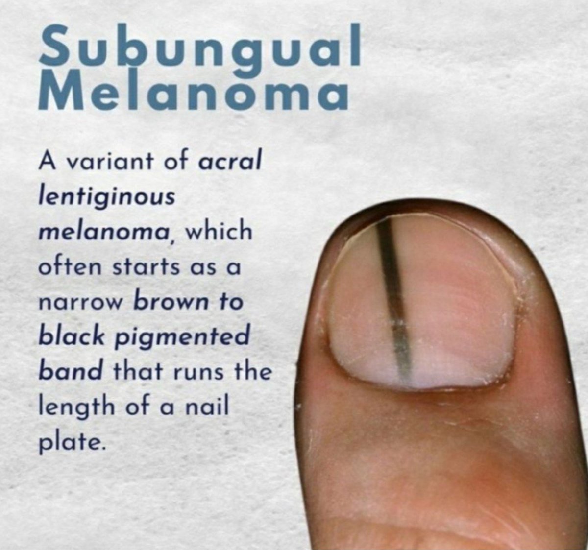 KaiMetaX's tweet photo. @DrMedica_13 C.Subungual melanoma

#DermTwitter #Nailcancer #nailtumor #cancer #skincancer #dermatology 

Rx-conservative nail unit excision for early stages to partial digit amputation for deeper, invasive tumors. If tumor has metastasized then SLNB,immunotherapy,targeted therapy/radiation https://t.co/EY3ugb1VvP