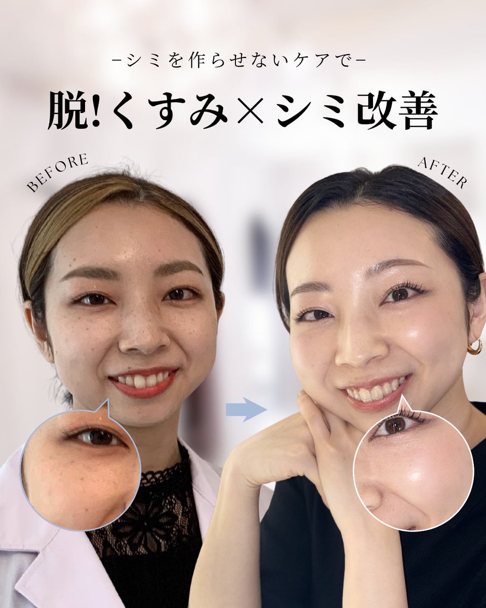 bebeaura_salon's tweet photo. シミ・そばかすケアでここまで肌が変わりました💎

☑︎夏の日焼けでシミが濃くなってきた
☑︎年齢を重ねてシミが目立ってきた
☑︎そばかすが気になる

そんな方は真似してみてください😌 https://t.co/cRWfplxljP