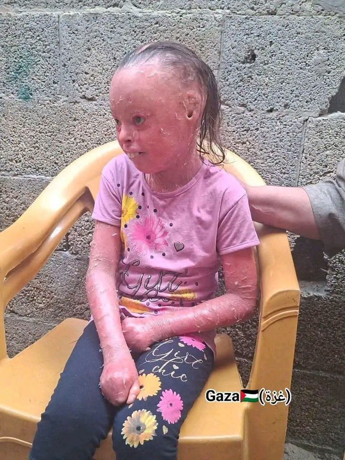 BirdOfFire10's tweet photo. @rebeccagrantdc @CENTCOM @AnitaJVogel @foymeetsworld @LexNextDC This is a gazan child who the Israelis won't let out of Gaza to get treatment......and Rebeccah wants these very same Israelis to go and liberate Iran!!!!!!!....yeah.......right....... https://t.co/3B9PFlpj01