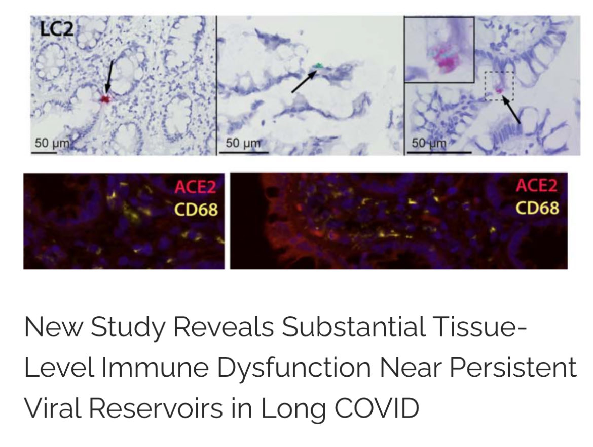 polybioRF's tweet photo. Breaking: New Study Reveals Substantial Tissue-Level Immune Dysfunction Near Persistent Viral Reservoirs in Long COVID 

👉🏻PolyBio-funded UCSF research finds persistent SARS-CoV-2 RNA alongside an altered gut immune response that may impair viral clearance 1/ https://t.co/Lrmh3ox29W