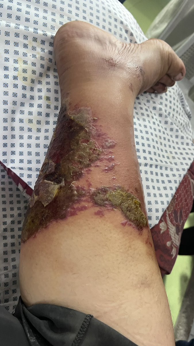 Tragic Consequences: Unidentified Insect Bite Highlights Health Crisis Under Siege