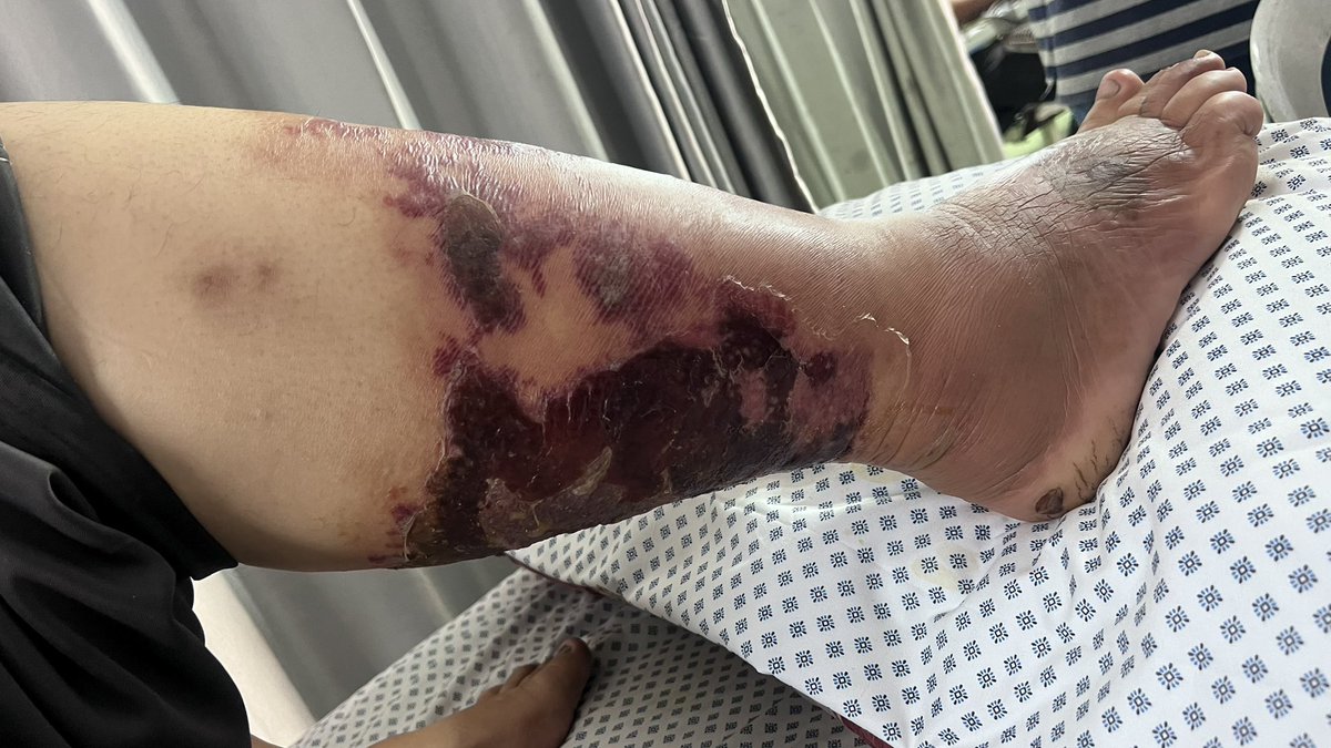AbujomaaGaza's tweet photo. If you want to know how life in tents looks like..

An unidentified insect bite our neighbour..

He spent one week in the ICU and has been in hospital fir 9 days..

No antidote or proper medicine due to the Israeli occupation siege.. https://t.co/qcZ8jGaOxj