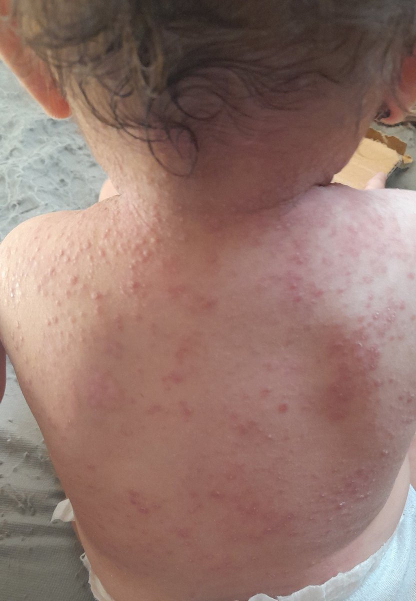 rola_almoghrabi's tweet photo. I NEED TREATMENT😭

︎
︎

︎

︎

︎
︎

︎

︎

︎

we’ll remind you 🥺
︎

︎

︎

︎

︎
︎

︎

︎

︎

︎
︎

︎
︎

︎
︎

︎

︎

︎

︎
︎

︎

︎

︎

that
︎

︎

︎

︎

︎

︎
︎

︎
︎
💔
︎

My child has scabies, please help me. $100
https://t.co/FLk3iM7URh https://t.co/ACpetKuWvi