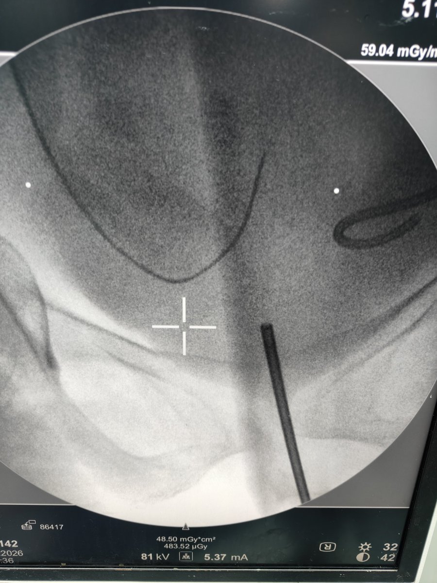 Eslam_wareth's tweet photo. Gyna and obstetric and it's relation to urology 
Female patient 70 years 
Post vaginal hysterectomy entrapment of the RT ureter in the sutures with closure of the intramural part  diagnostic cystoscopy not visualised 
PNC and antigrade contrast injection and wire not passed https://t.co/OABxsMa2Ka