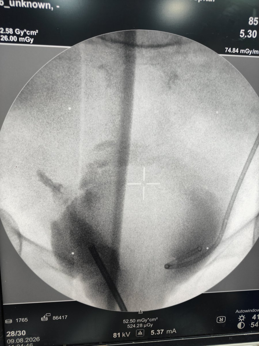 Eslam_wareth's tweet photo. Gyna and obstetric and it's relation to urology 
Female patient 70 years 
Post vaginal hysterectomy entrapment of the RT ureter in the sutures with closure of the intramural part  diagnostic cystoscopy not visualised 
PNC and antigrade contrast injection and wire not passed https://t.co/OABxsMa2Ka