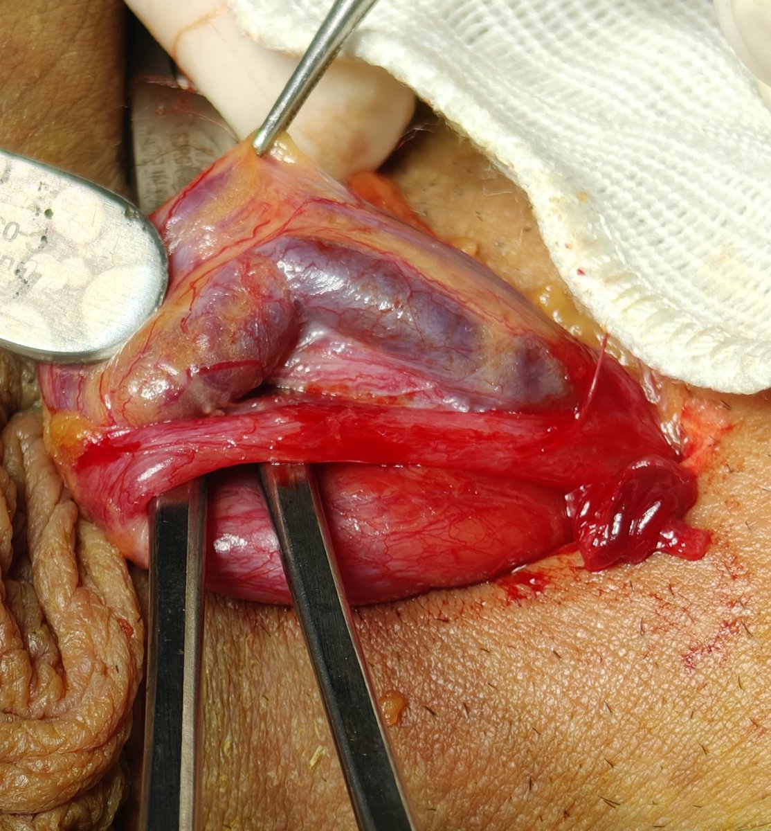 Eslam_wareth's tweet photo. Challenge of doin subinguinal microscopic varicoclectomy with Mimi incision not exceeding 1 cm 
#urology #andrology #surgery #varicocele #fertility https://t.co/3QiI4jXQBC