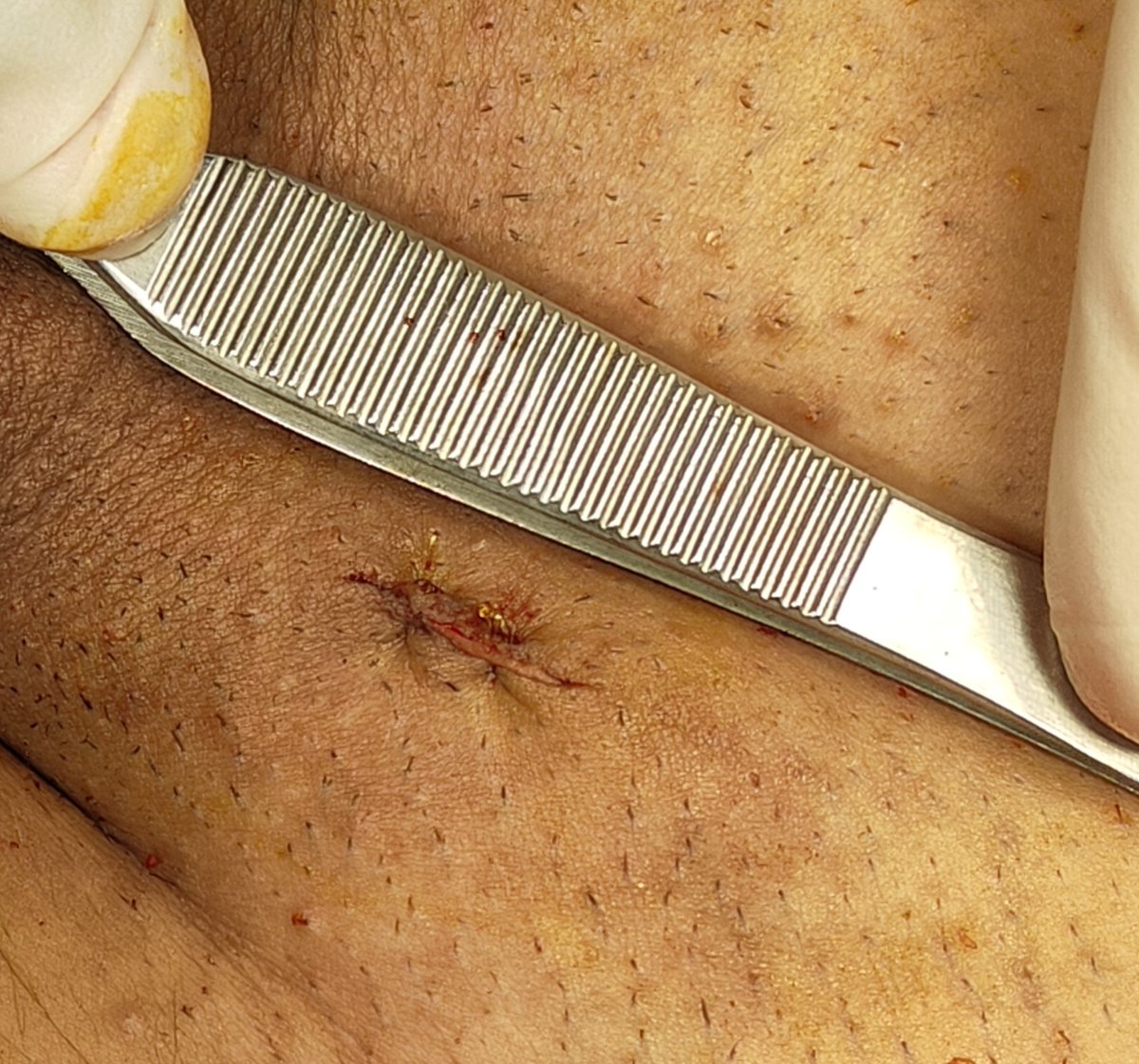 Eslam_wareth's tweet photo. Challenge of doin subinguinal microscopic varicoclectomy with Mimi incision not exceeding 1 cm 
#urology #andrology #surgery #varicocele #fertility https://t.co/3QiI4jXQBC