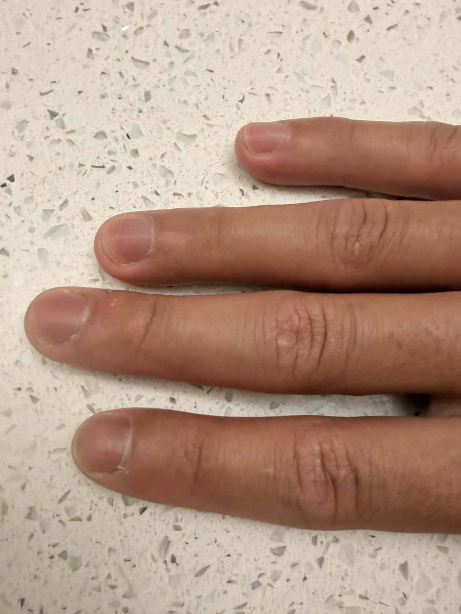 GenghisJawnson's tweet photo. You ever cut your nails too short? What do you do? Am I doing this shit right? https://t.co/7zQopfTfLQ