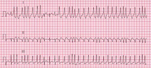 ANHMM1418's tweet photo. أداة خرافية مجانية من جامعة هارفارد!  

ECG Wave-Maven: منصة موجودة لتطوير مهارات قراءة الECG 🙋🏻‍♂️🫀

أكثر من ٤٠٠ حالة وسيناريوهات حقيقية Peer-Reviewed + شروحات مفصلة  
تقدر تحل بنمط اختبار أو تصفح عادي  

 للأطباء، المقيمين، طلاب الطب والتمريض!  

الرابط 👇🏻🕰️ https://t.co/NY5sh6GvAf