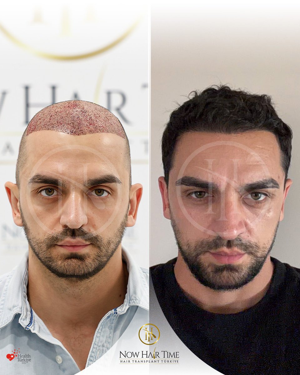 nowhairtime's tweet photo. Real change begins with results that seem natural
Now Hair Time | Quality Service, Affordable Price!
🔬 Technique: Sapphire FUE + DHI — NW3
💉 Grafts: 5200 grafts
📅 Pre-op: Fireplace 2026
📅 Post-op: July 2026
#hairtransplant #hairtransplantresult #nowhairtime #beforeafter #nw3 https://t.co/W0CaCkEzel
