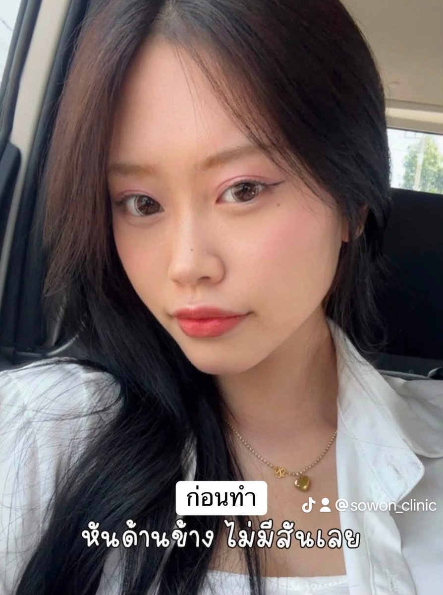SowonClinic's tweet photo. เมื่อก่อนยังไม่เริ่ด ตอนนี้เป็นลูกสาวโซวอนแล้วสวยหวานมาก 💞 ตรงปกไม่ให้ภาพเล่าเรื่อง #sowonclinic https://t.co/JOAIw0BKSZ