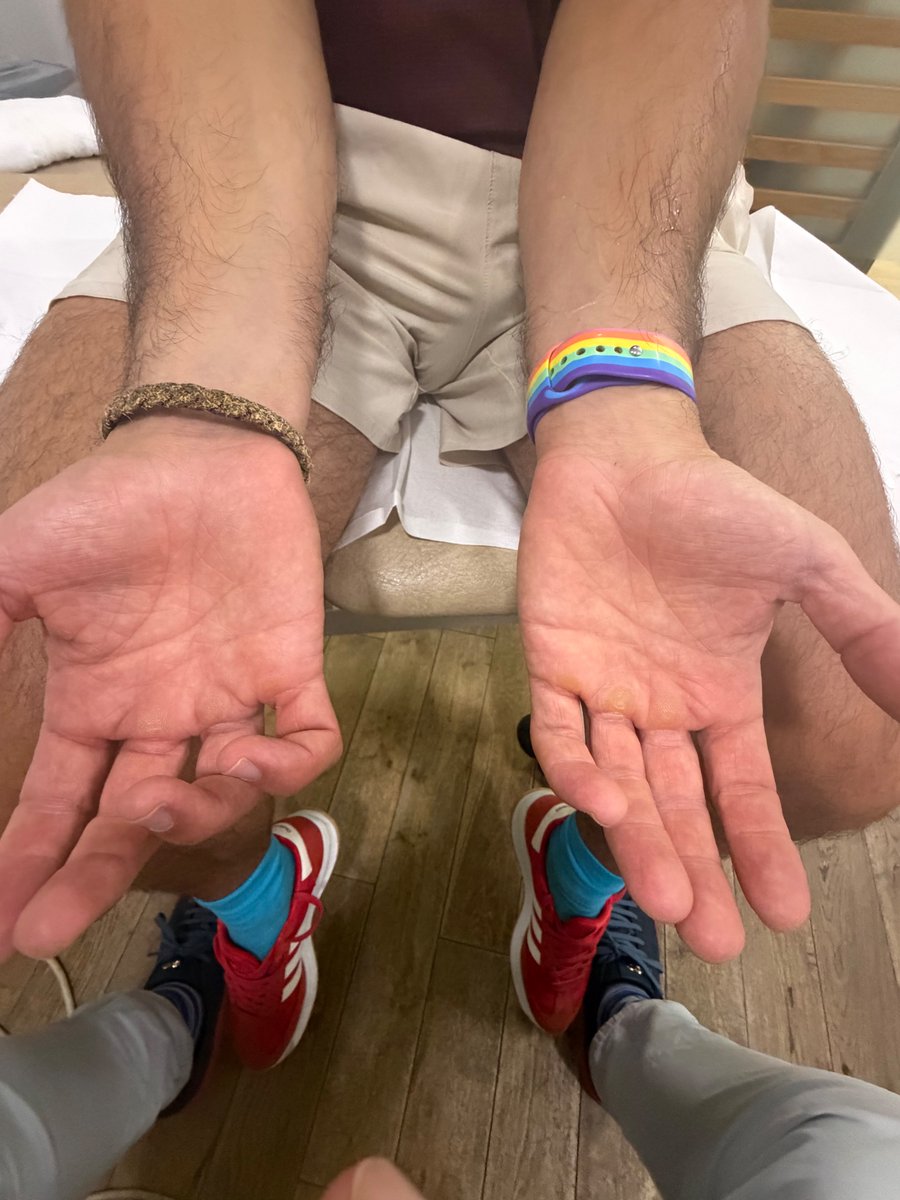 DrJN_SportsMed's tweet photo. Consent ✅

Professional acrobat - developed R sided hypothenar eminence pain with repetitive loading with compression

Developed 'tight' forearms - osteopath undertook cupping therapy along the ulnar aspect of the flexor compartment up to the medial elbow level

There was significant bruising and swelling post cupping

He then developed clawing of the hand (see picture), weakness in wrist flexion, power grip and finer motor skills eg eating, writing

Unable to train & work

OE - 

Clawing of ulnar digits

Hypothenar wasting, loss of finger abduction / adduction power, positive Froment's test (see video)

POCUS L vs R ulnar nerve in transverse - R is swollen and approx 40% greater calibre than L side 

Diagnosis - ulnar neuropraxia

Pearls - 

Passive interventions eg cupping, acupuncture are not completely risk free and benign - I've seen full thickness burns from cupping requiring skin grafting, and several pneumothoraces from dry needling

The clawing is due to weakness of the interossei and lumbricals, with unopposed action of the extensors

The 'ulnar paradox' - the more proximal and severe (this chap) the nerve injury, the more subtle the clawing is, because the ulnar sided digital flexors are knocked out too which re-balances the deformity caused by the intrinsic loss
