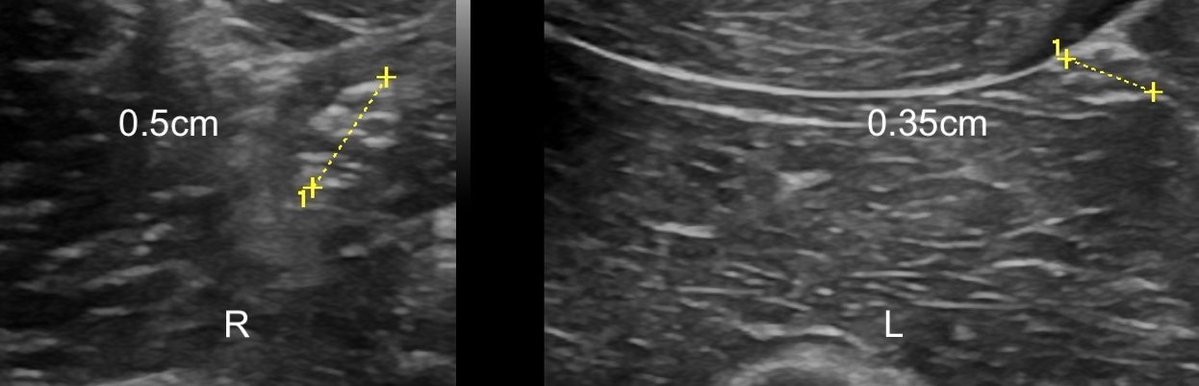 DrJN_SportsMed's tweet photo. Consent ✅

Professional acrobat - developed R sided hypothenar eminence pain with repetitive loading with compression

Developed 'tight' forearms - osteopath undertook cupping therapy along the ulnar aspect of the flexor compartment up to the medial elbow level

There was significant bruising and swelling post cupping

He then developed clawing of the hand (see picture), weakness in wrist flexion, power grip and finer motor skills eg eating, writing

Unable to train & work

OE - 

Clawing of ulnar digits

Hypothenar wasting, loss of finger abduction / adduction power, positive Froment's test (see video)

POCUS L vs R ulnar nerve in transverse - R is swollen and approx 40% greater calibre than L side 

Diagnosis - ulnar neuropraxia

Pearls - 

Passive interventions eg cupping, acupuncture are not completely risk free and benign - I've seen full thickness burns from cupping requiring skin grafting, and several pneumothoraces from dry needling

The clawing is due to weakness of the interossei and lumbricals, with unopposed action of the extensors

The 'ulnar paradox' - the more proximal and severe (this chap) the nerve injury, the more subtle the clawing is, because the ulnar sided digital flexors are knocked out too which re-balances the deformity caused by the intrinsic loss