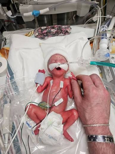 LifeNewsHQ's tweet photo. Here is a premature baby at 24 weeks.

Massachusetts just legalized killing babies like this in abortions. https://t.co/WqmOIh3dBa