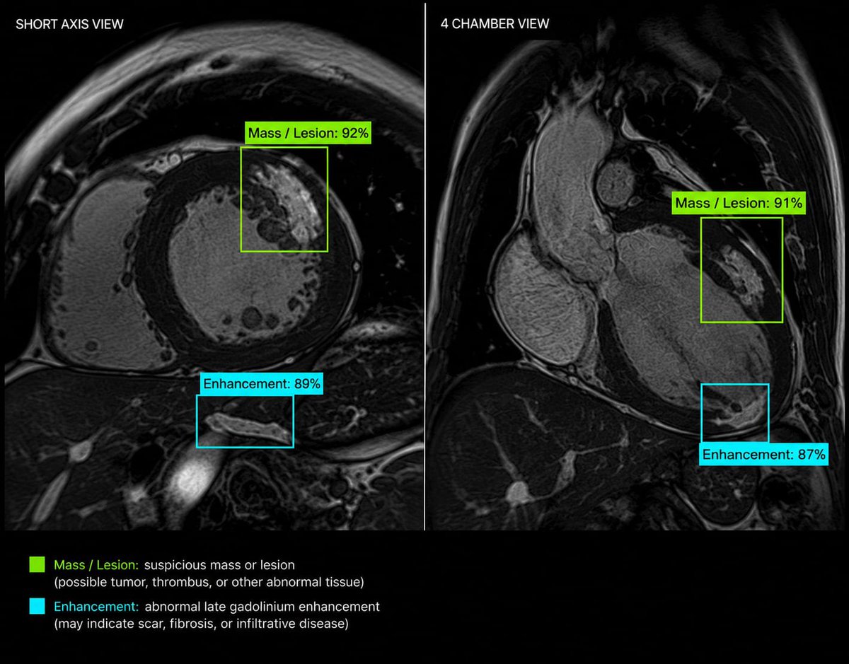 scanwithagera's tweet photo. Agera analyzes cardiac MRI across multiple views to identify suspicious masses, lesions, and abnormal enhancement patterns.

Helping clinicians locate findings that may require closer evaluation. https://t.co/A1i85MQkHC