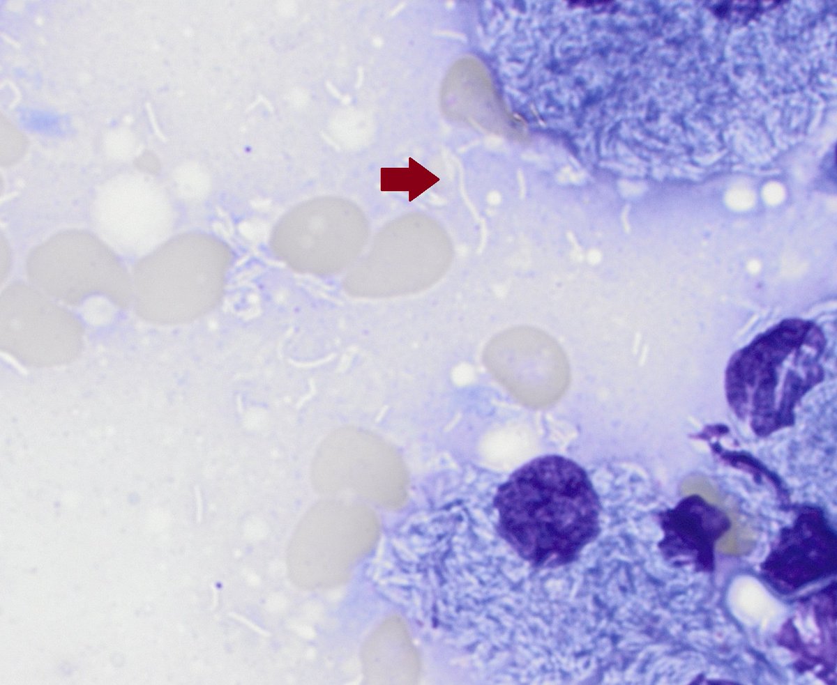 CUHemepath's tweet photo. These are pseudogaucher cells. These can be seen in many conditions including thalassemia and myeloma. This case was disseminated mycobacteria. The organisms can be seen extracellularly as negative images against the background stain. AFB was positive and PCR confirmed MAC. https://t.co/OqlnUevQOk