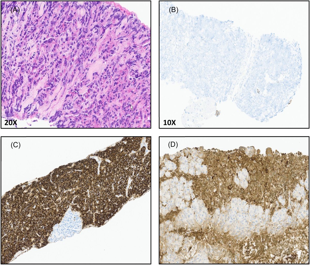 JPGNReports's tweet photo. #Pancreas mass in a 3 yr: 
Hematoma, autoimmune pancreatitis, or myeloid sarcoma? 

Monga et al. share a rare diagnostic twist, highlighting #EUS biopsy and molecular testing. 

🔗 https://t.co/0A1RduqEgP

#PedsGI #MRCP #GIPath #MedTwitter #GITwitter https://t.co/9cR2wHT550