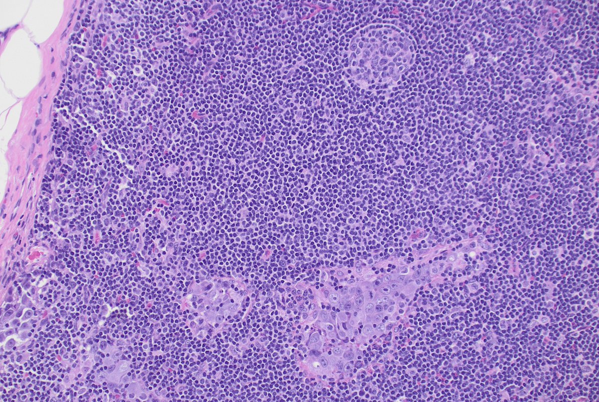 CUHemepath's tweet photo. Sharing a rare/hard case for the #hemepath enthusiasts. This presented in a young adult. 

Hint: note the pattern of involvement. I'll be sharing a few stains throughout the next few days. https://t.co/mzhoLK5PhR