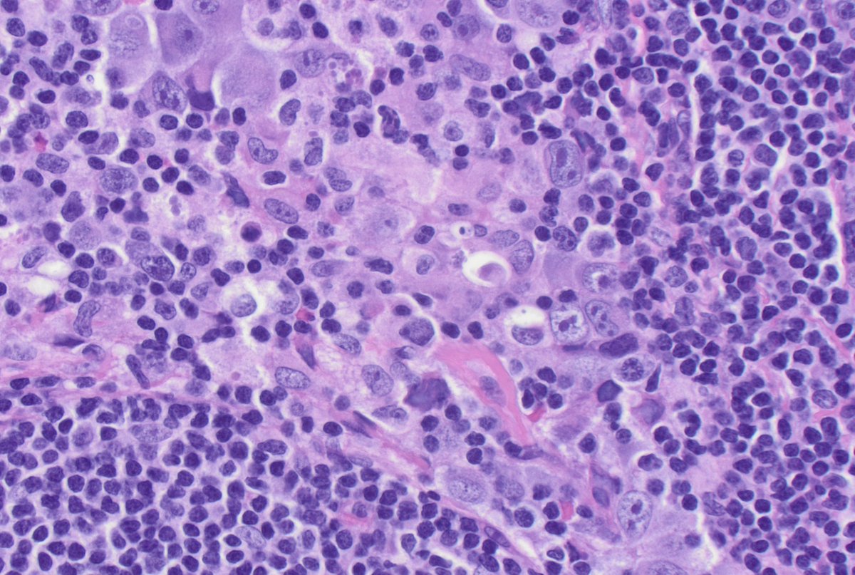 CUHemepath's tweet photo. Sharing a rare/hard case for the #hemepath enthusiasts. This presented in a young adult. 

Hint: note the pattern of involvement. I'll be sharing a few stains throughout the next few days. https://t.co/mzhoLK5PhR