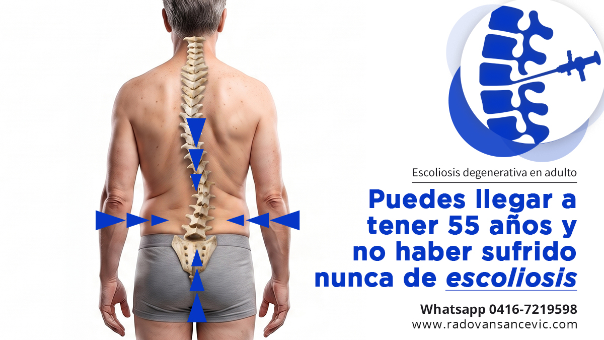 RadovanSancevic's tweet photo. Nunca tuviste escoliosis.
Hoy la radiografía dice que sí.
¿Cómo es posible?
Casi todos creemos que la escoliosis es cosa de la adolescencia.
Pero existe un tipo que nace en la adultez, desde cero: la escoliosis degenerativa de novo. No la tuviste de joven. Se formó con los años.
Con el tiempo, los discos y las articulaciones de la columna se desgastan. Cuando ese desgaste es mayor de un lado que del otro, la columna cede hacia el lado más gastado y empieza a torcerse.
Como una torre cuyos cimientos ceden de un solo costado.

Aparece sobre todo entre los 50 y los 60 años. Es más frecuente en mujeres, especialmente después de la menopausia, y se asocia a la osteoporosis.
Muchas veces avanza tan lento que ni se nota cuándo empezó.
→ Dolor lumbar que empeora de pie o al caminar
→ Dolor u hormigueo que baja por la pierna
→ Piernas que pesan al caminar y alivian al sentarse
→ La sensación de irse hacia adelante, de perder la postura

En el adulto no importa tanto cuánto se tuerce la columna, sino si duele, si comprime un nervio y si pierde el equilibrio.
Escribe en los comentarios si tienes alguno de estos síntomas.

#RadovanSancevic