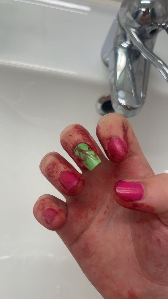 bl00dfilldbaths's tweet photo. HOMER LEFT THE MF BARTS OUT. Blade got dull but I WAD SO CLOSE TO FASCIA (this is all fake, just makeup, im a professional makeup artistk) #beans https://t.co/3OdgQH8ND3