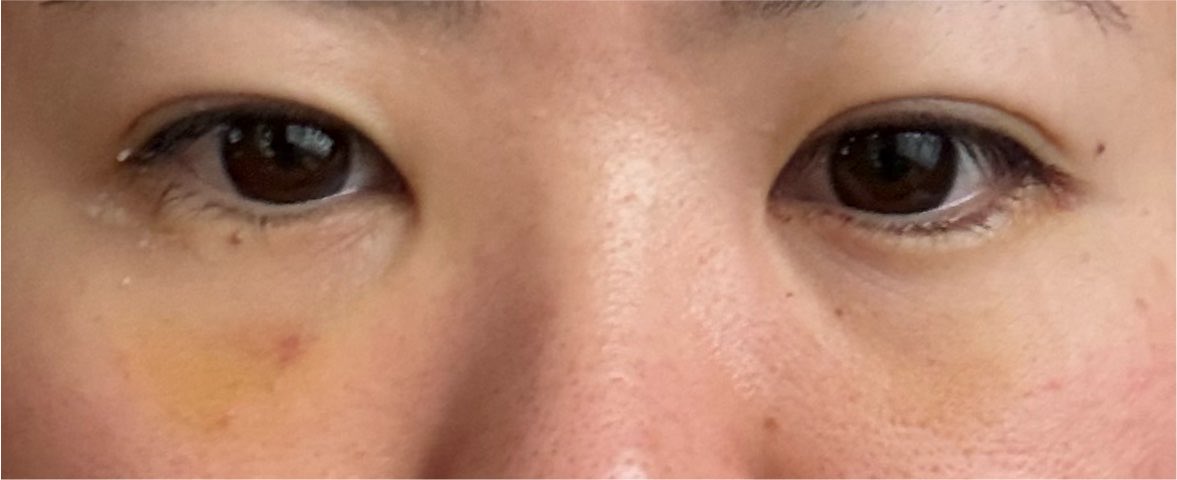 BswDk's tweet photo. 上まぶたが厚すぎるため、副作用的に上まぶたの脂肪が下に落ちてくれたら理想 https://t.co/BHc1pdxKsw