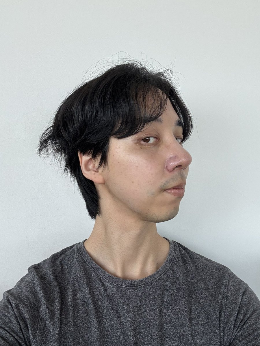 seikei1357's tweet photo. ずっと中顔面を短くする手術を考えていました。色々と情報収集をする中でEU口腔顔面外科の評判が高く、相談した結果、両顎手術と顎先形成で改善することが分かったのでお願いすることにしました。病院は駅から近く、スタッフの皆さんもとても親切でした。先生は質問にも的確に答えていただきました。 https://t.co/tiKgGVpxOj