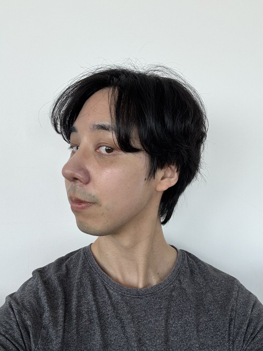 seikei1357's tweet photo. ずっと中顔面を短くする手術を考えていました。色々と情報収集をする中でEU口腔顔面外科の評判が高く、相談した結果、両顎手術と顎先形成で改善することが分かったのでお願いすることにしました。病院は駅から近く、スタッフの皆さんもとても親切でした。先生は質問にも的確に答えていただきました。 https://t.co/tiKgGVpxOj