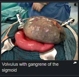 _fr8r's tweet photo. Fuck My Gangrenous Sigmoid Life Bro It's OVER For Me. https://t.co/MtqTn0ldPE