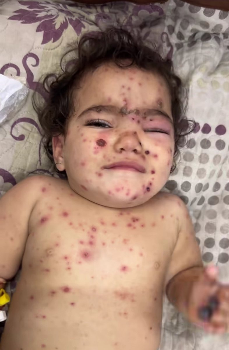 Razieh_7's tweet photo. خدایا به حق تک تک ترکش های بدن این بچه فلسطینی، اسراییل را نیست  نابود کن!💔 https://t.co/zdRTINbVrD